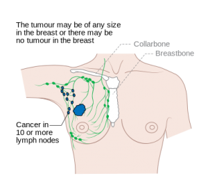 Diagram_1_of_3_showing_stage_3C_breast_cancer_CRUK_399.svg