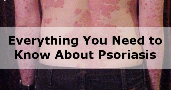 psoriasis back