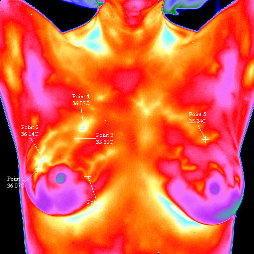 Breast Cancer Right Sample