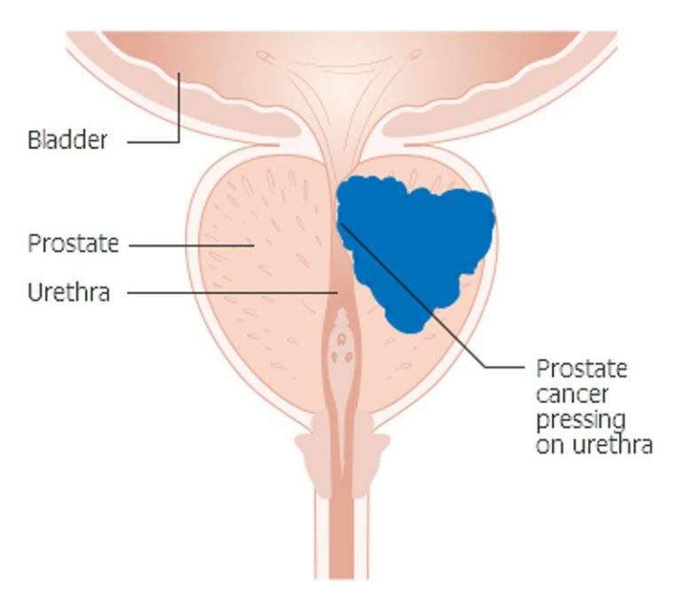 Diagram_showing_prostate_cancer_pressing_on_the_urethra